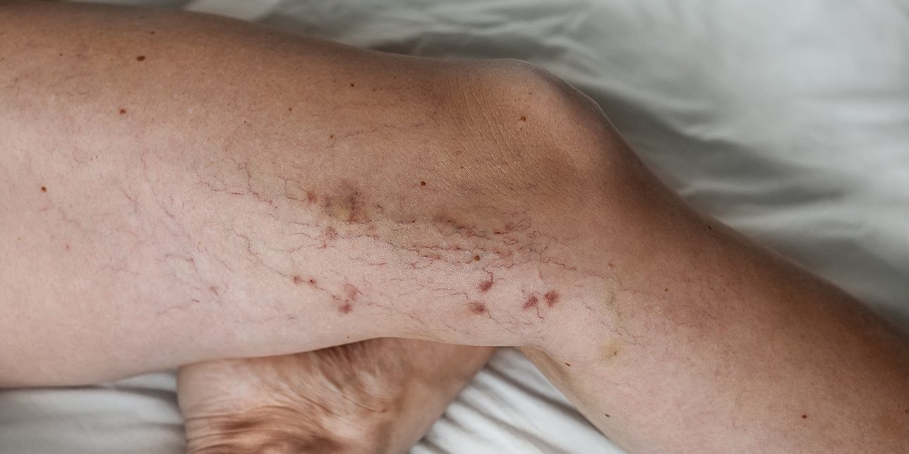 Varicose veins